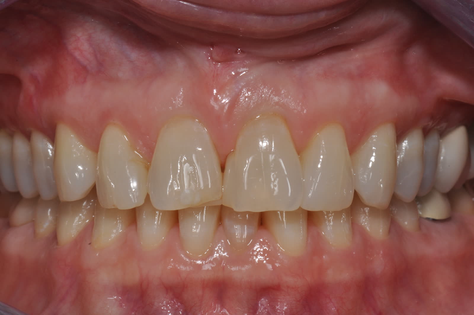 Before-Front Crowns