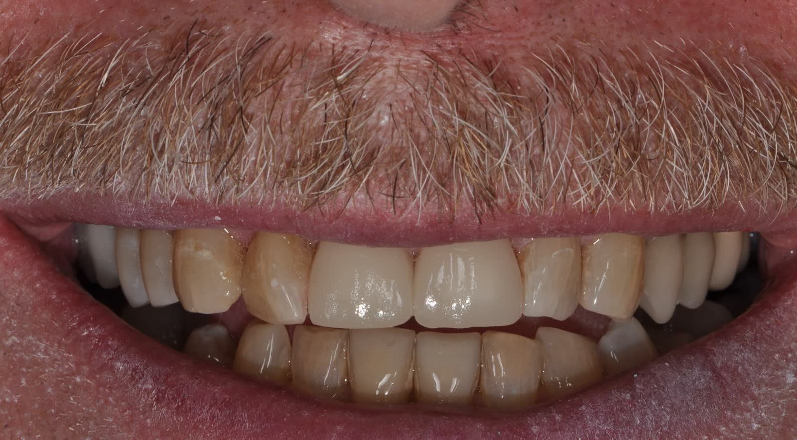 After-Front Crowns