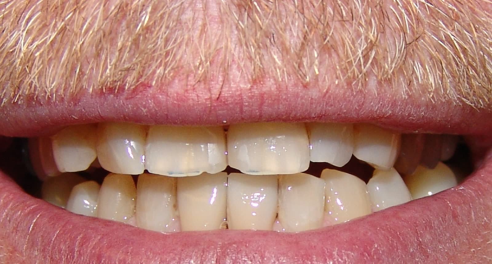Before-Front Crowns