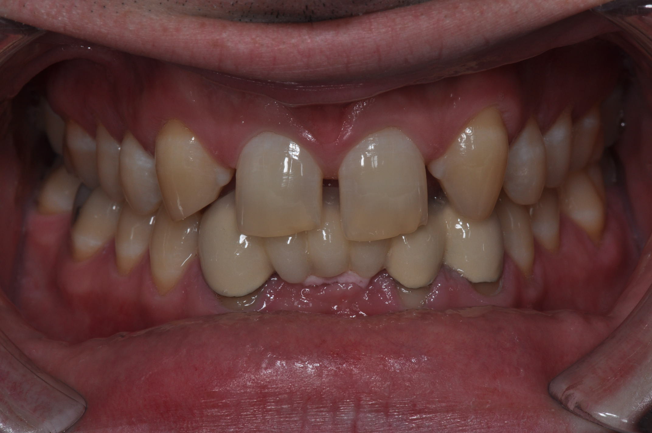 Before-Ortho and Implants