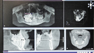 585 Dentist (65) CT Scan 2