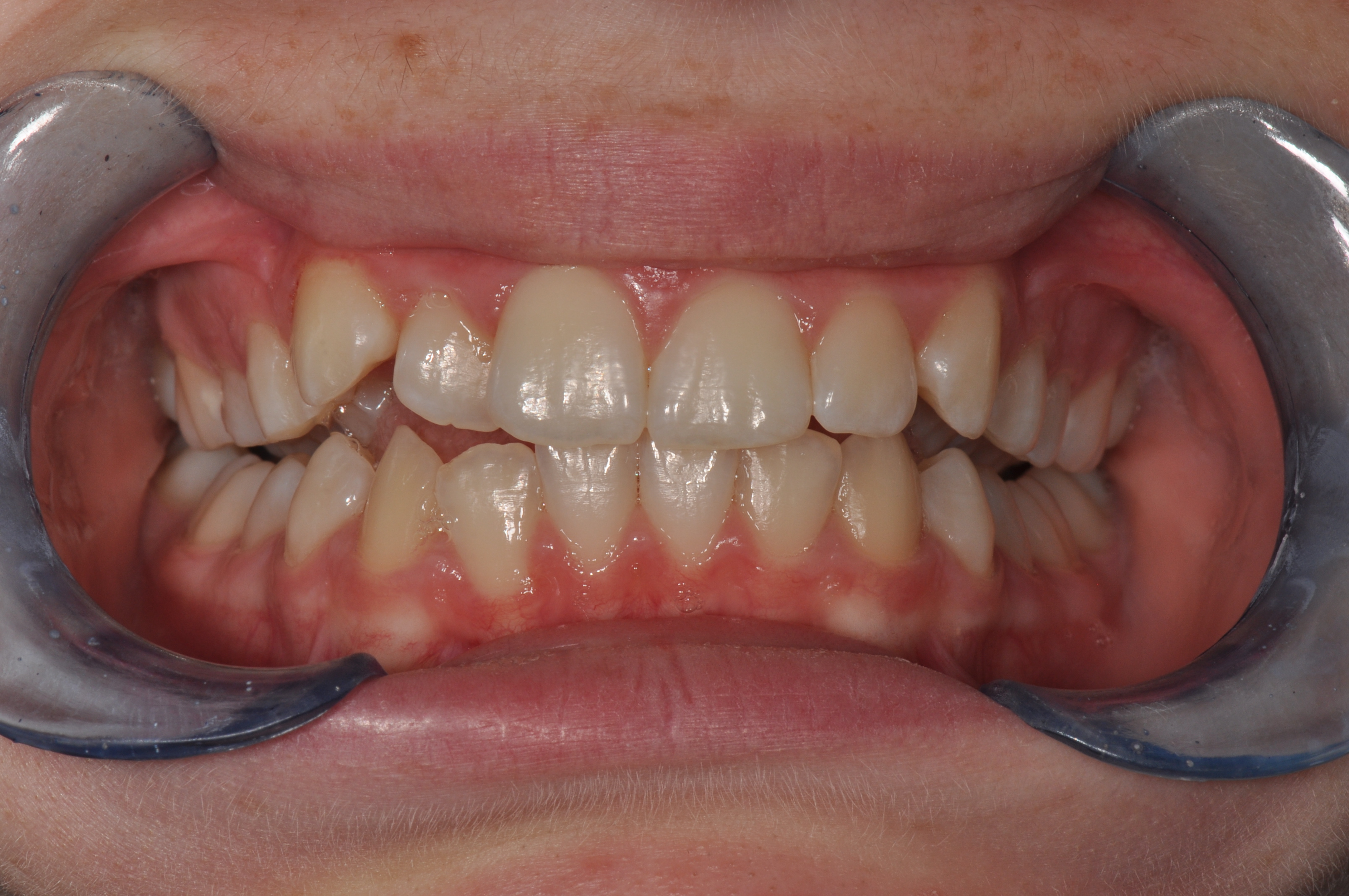 Before-Orthodontics