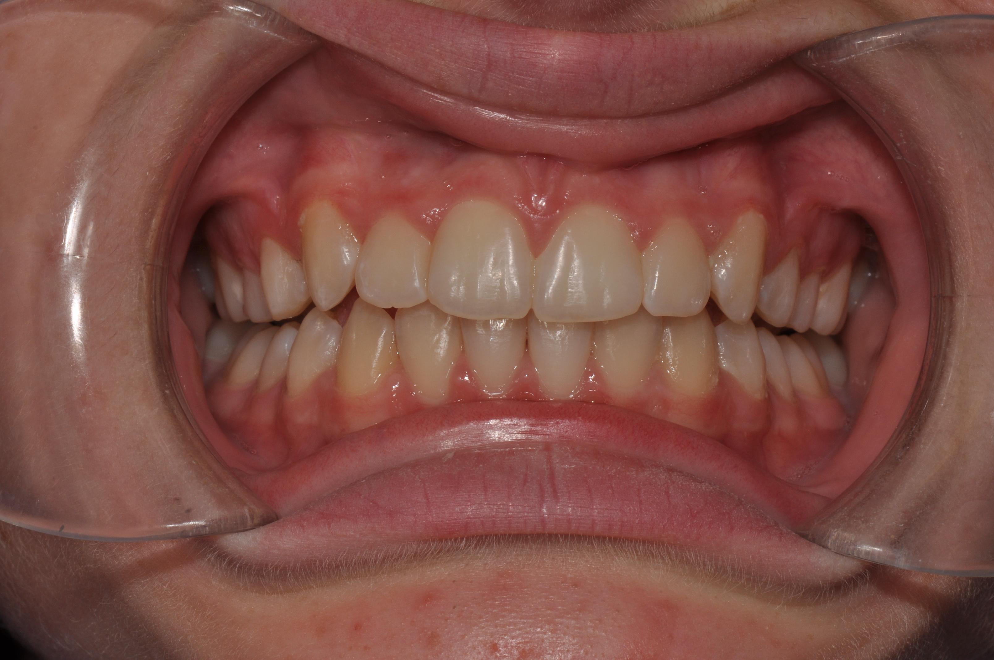 After-Orthodontics