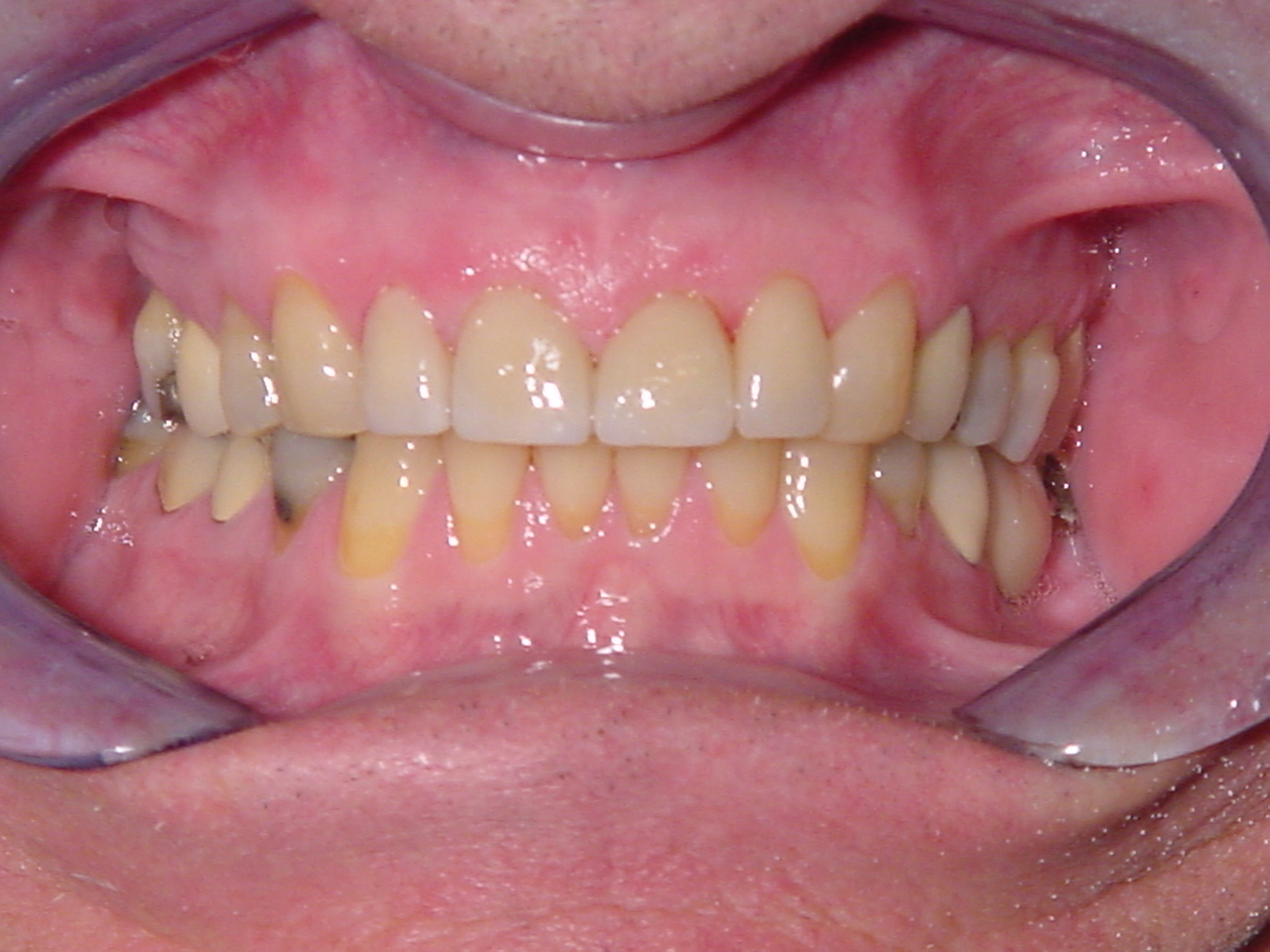 After-Front Crowns