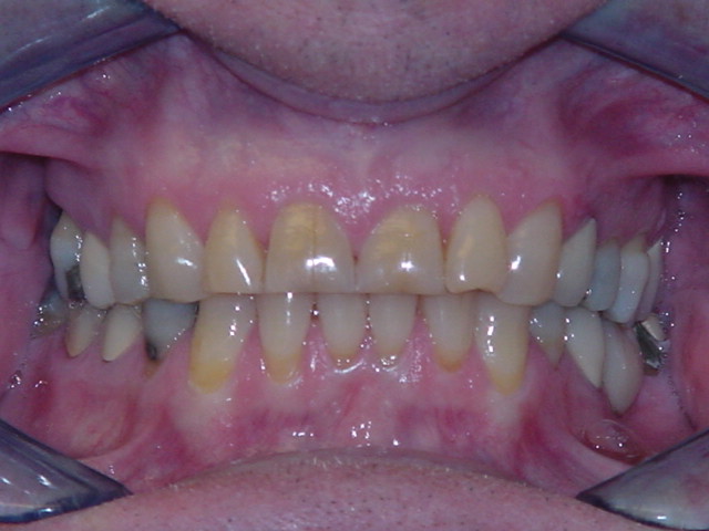 Before-Front Crowns