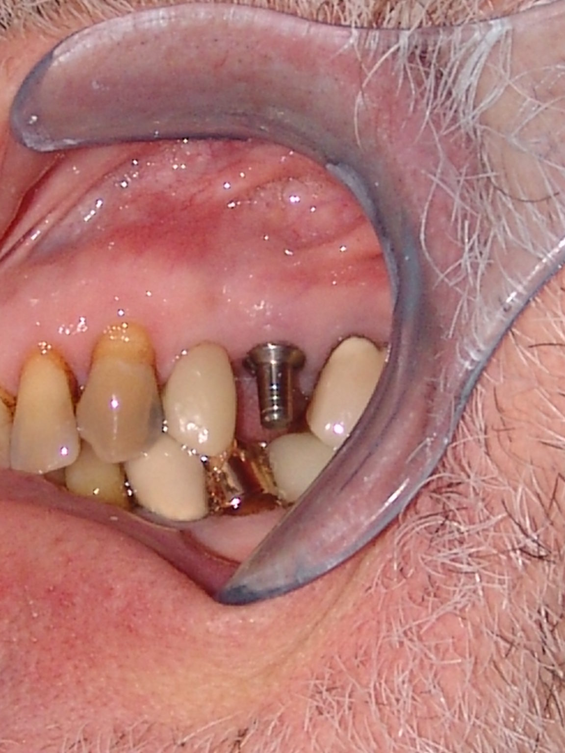 Before-Implant Restoration 