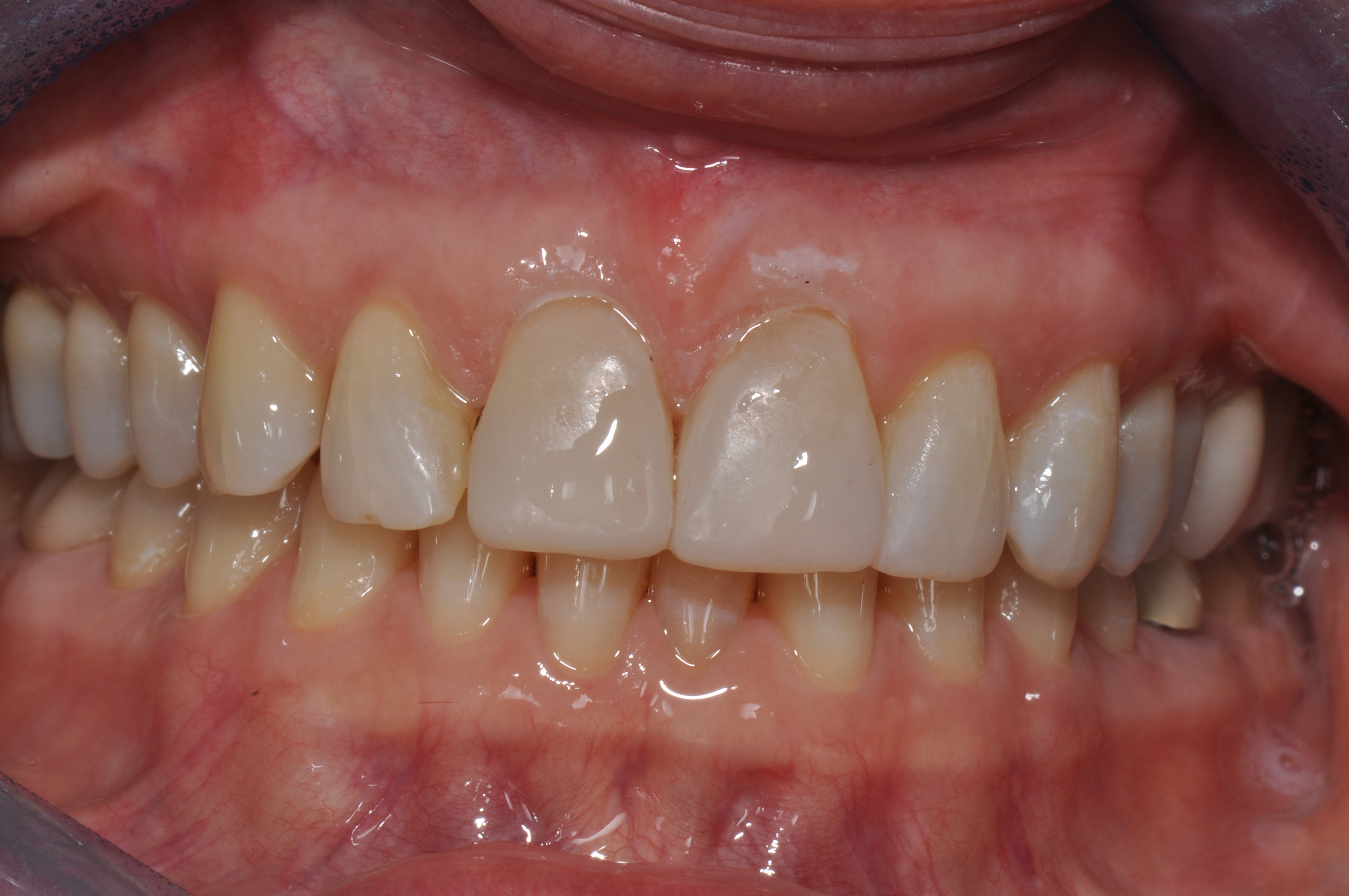 After-Front Crowns 