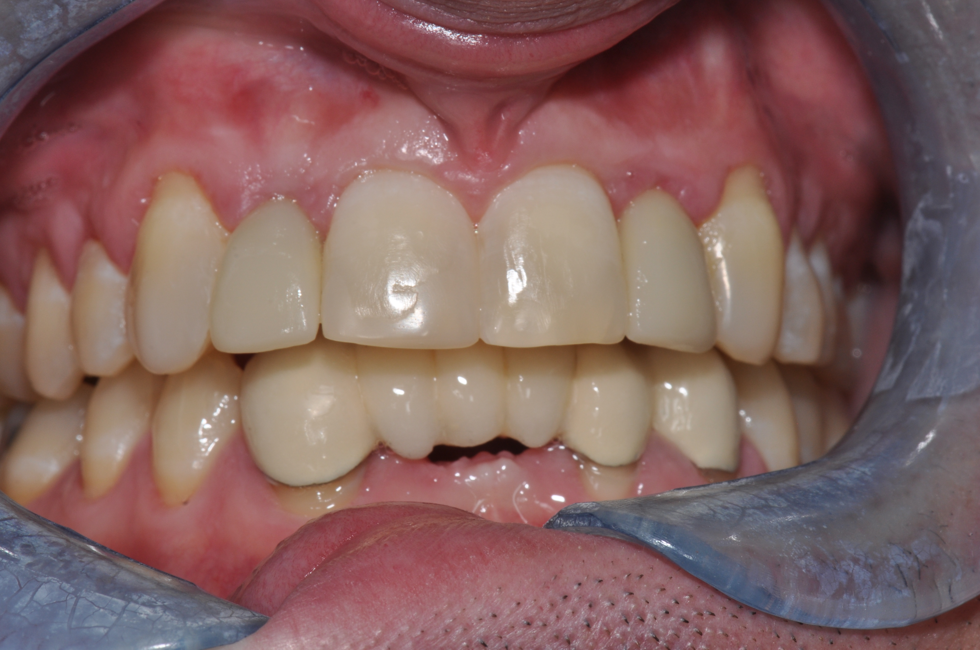 After-Ortho and Implants 